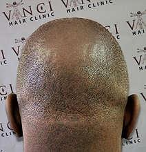 Тату причёски - реалистичные волосы «избавьтесь от облысения навсегда»