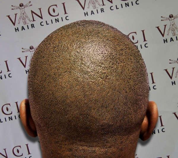 Татуировка микро скальп-пигментация до и после