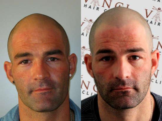 Тату на лысине до и после