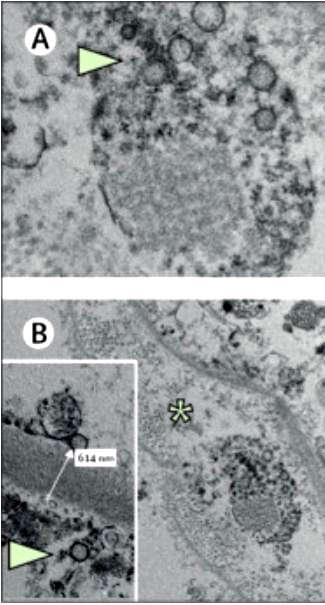 SARS CoV 2 почки