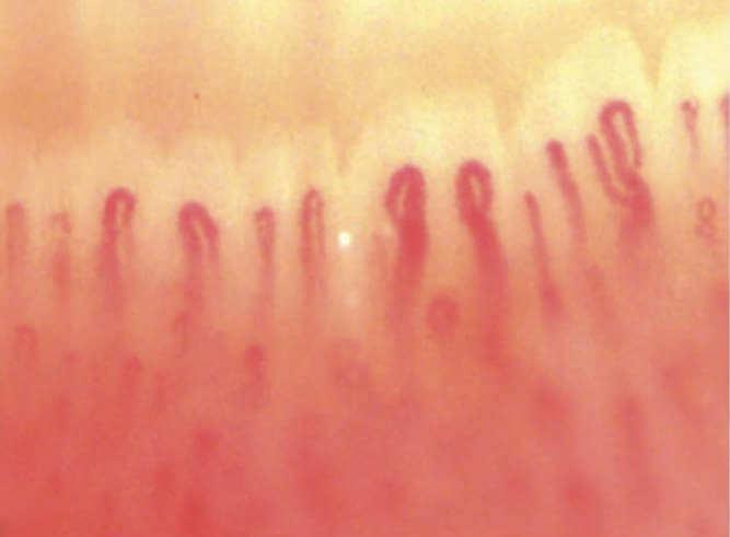 Капиллярная микроскопия