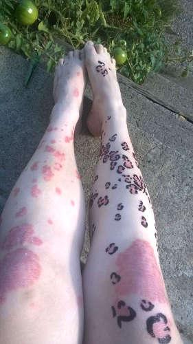 Псориаз, дерматит