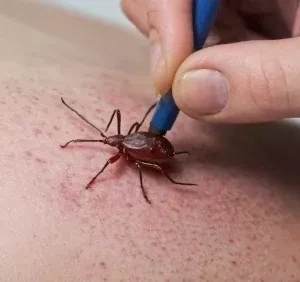 Как снять клеща