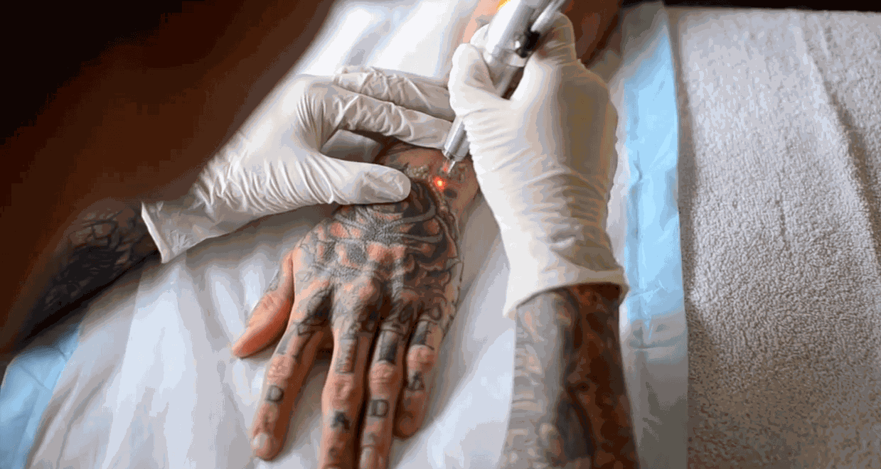 Татуировки - удаление татуировок лазером