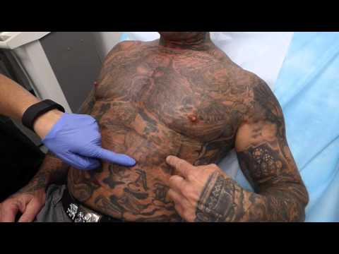 Massive Chest Tattoo Removal at Dr. Tattoff